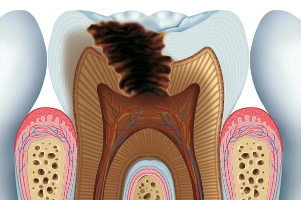 Zahn mit Karies - Wurzelbehandlung - ZahnarztAubing Dr. Johannes Stern, M.Sc. München