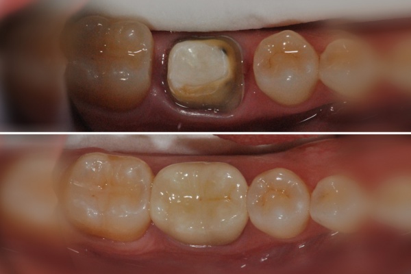 Krone auf wurzelkanalbehandeltem Zahn - Wurzelbehandlung - ZahnarztAubing Dr. Johannes Stern, M.Sc. München