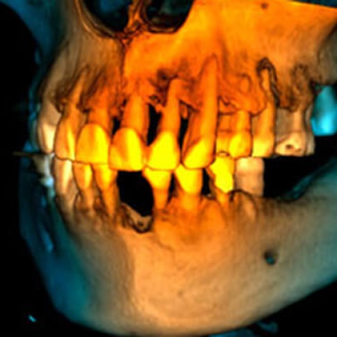 DVT Implantatplanung - ZahnarztAubing Dr. Johannes Stern
