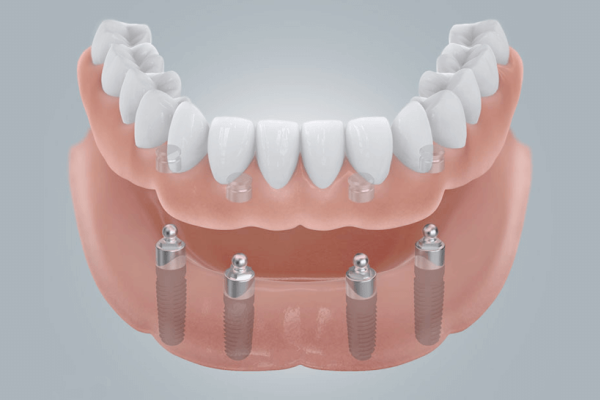 Unterkieferprothese mit Kugelkopfankern - Implantologie - ZahnarztAubing Dr. Johannes Stern, M.Sc. München