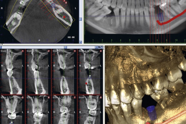 3D-Implantatplanung - Implantologie - ZahnarztAubing Dr. Johannes Stern, M.Sc. München