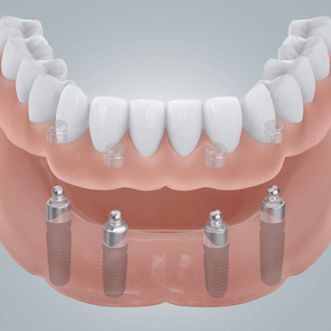 Unterkieferprothese mit Kugelkopfankern - ZahnarztAubing Dr. Johannes Stern
