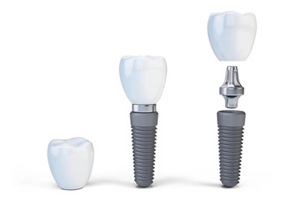Aufbau Implantat mit Krone - Implantologie - ZahnarztAubing Dr. Johannes Stern, M.Sc. München