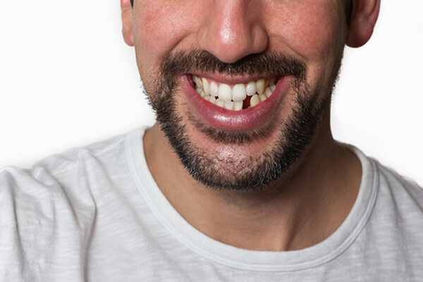 Zahnlücke im sichtbaren Bereich - Implantologie - ZahnarztAubing Dr. Johannes Stern, M.Sc. München