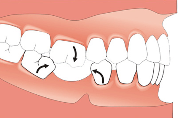 Zahnkippen infolge Zahnverlust - Implantologie - ZahnarztAubing Dr. Johannes Stern, M.Sc. München